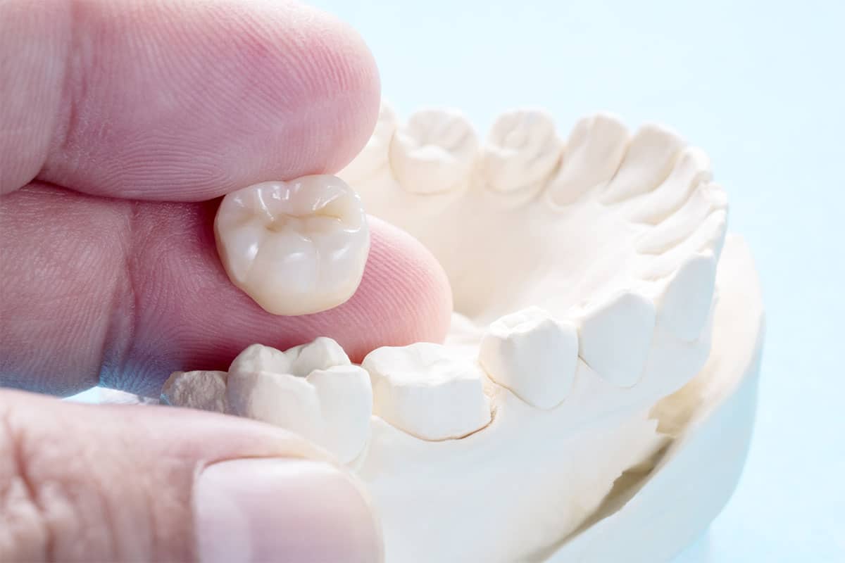 Dental crown model image