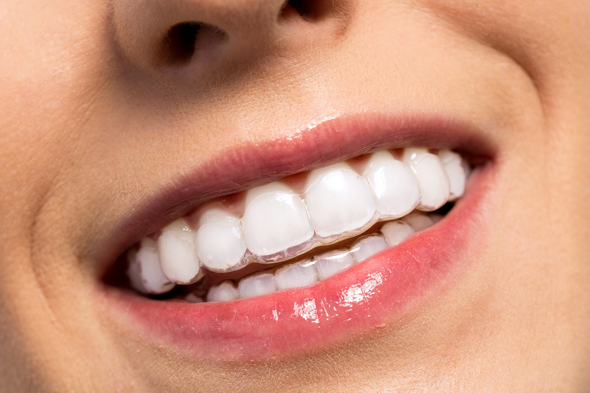 How long does invisalign treatment take blog