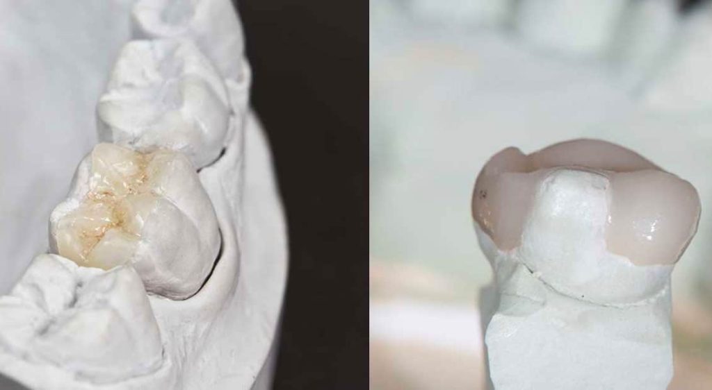 Dental Inlays and Onlays in Morristown, NJ | Dentex Smile Studio