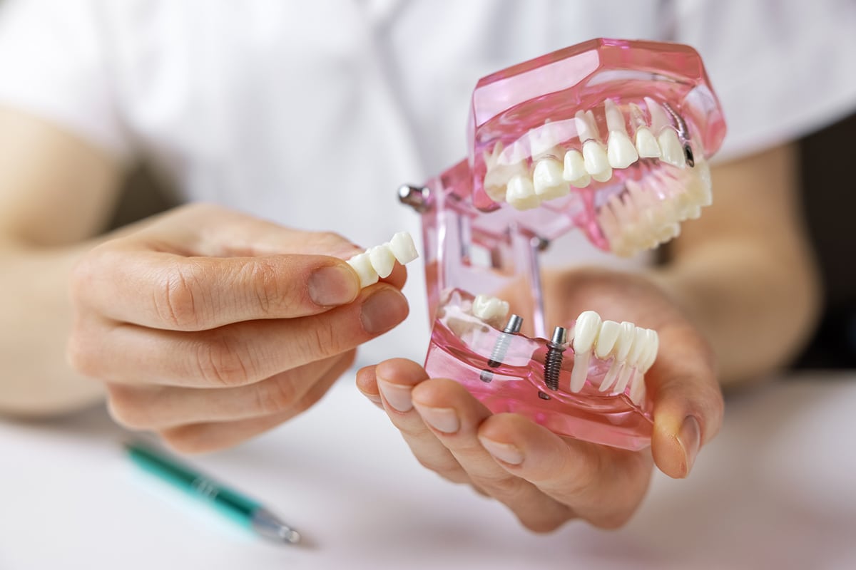 The true cost of dental implants vs bridges in bernardsville blog