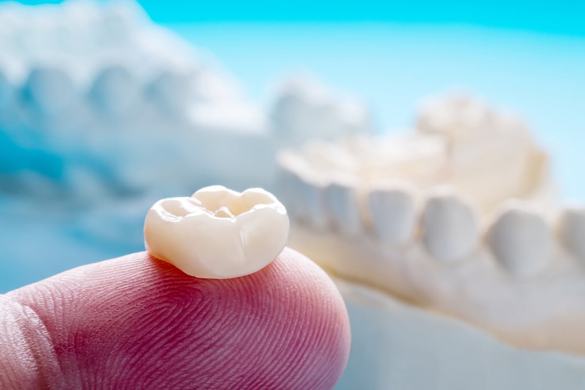 Understanding the cost factors for same day dental crowns in bernardsville blog